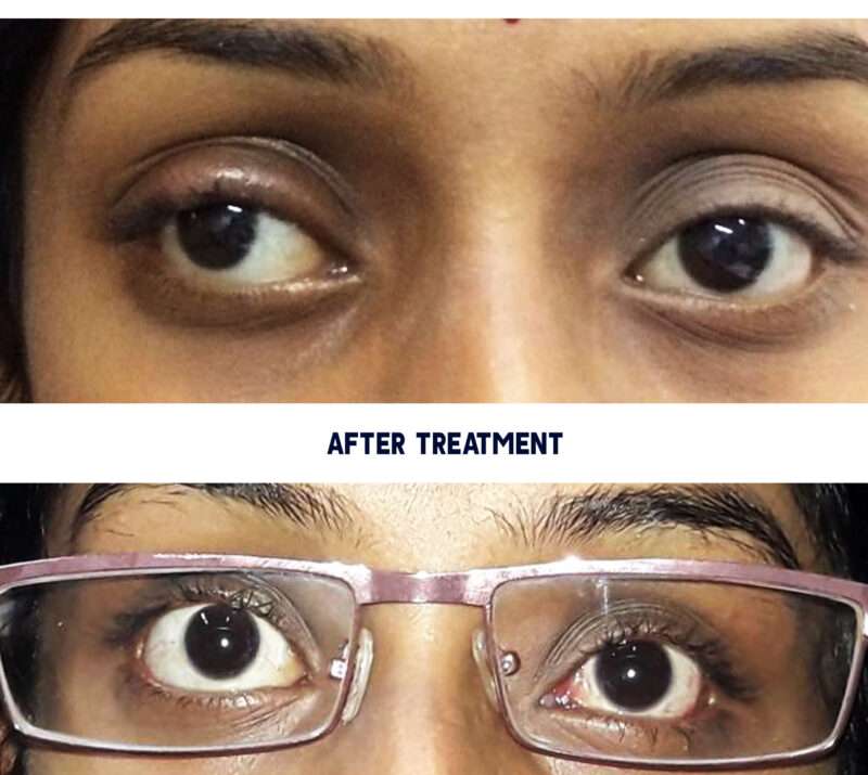 squint eye treatment
