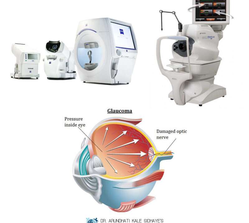 Glaucoma treatments